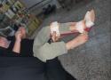 قسم المساعدات الخيرية يتبنى علاج الطفل غيث حسين والذي يعاني من اعوجاج في الساق 